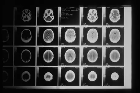 brain injury xray